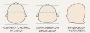 braquicefalia - visões
