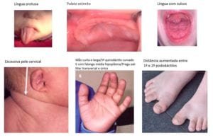 sintomas da síndrome de down - parte 02