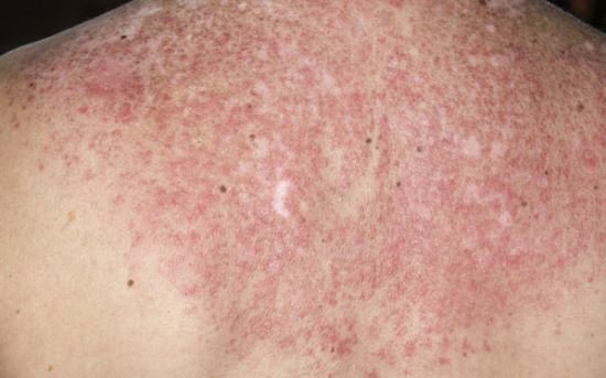 Lúpus Eritematoso em Pediatria: novos critérios diagnósticos e ...