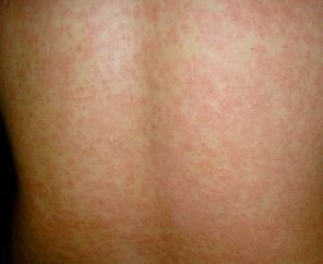 Lúpus Eritematoso em Pediatria: novos critérios diagnósticos e ...