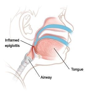 Epiglotite
