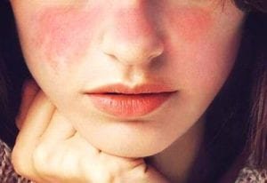 lupus - reacao na face