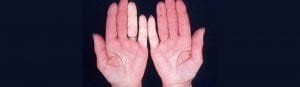tratamento da sindrome de raynaud