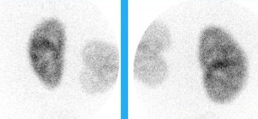 exemplo cintilografia renal