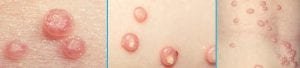 molusco contagioso - exemplos
