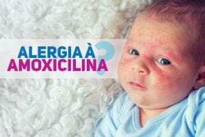alergia a penicilina amoxicilina pediatria