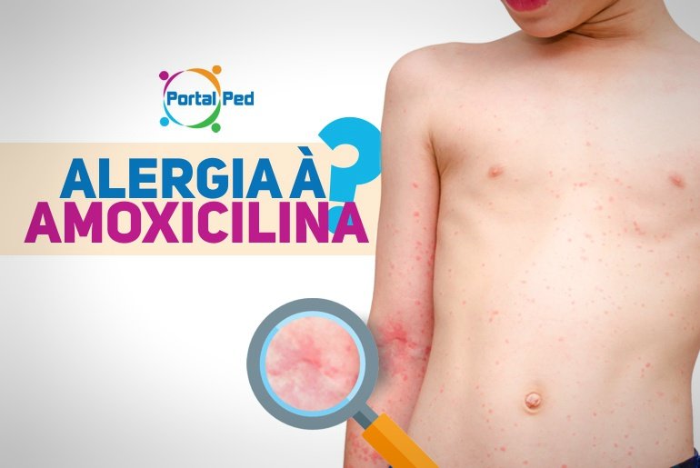 alergia a penicilina e amoxicilina 2