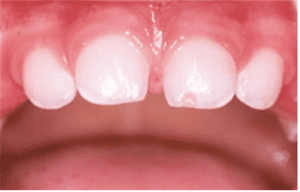 Fratura de esmalte do dente 61