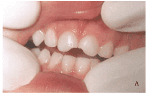 Fratura do esmalte e dentina dos dentes 51 e 61