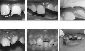 traumas dentarios - 01
