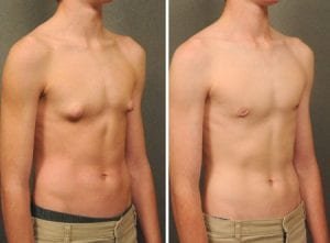 ginecomastia - antes e depois de cirurgia