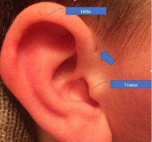 Sinus preauricular