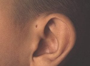 Coloboma auris - Sinus - imagem 1