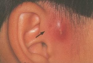Coloboma auris - Sinus - imagem 2