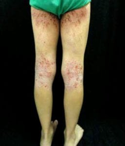 dermatite atopica - figura 04