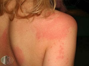 urticaria em crianca - pediatria