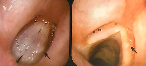 cisto epidermoide