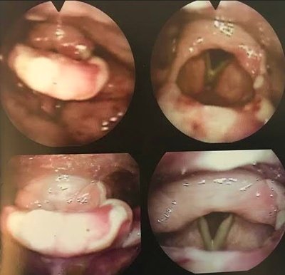 laringite catarral