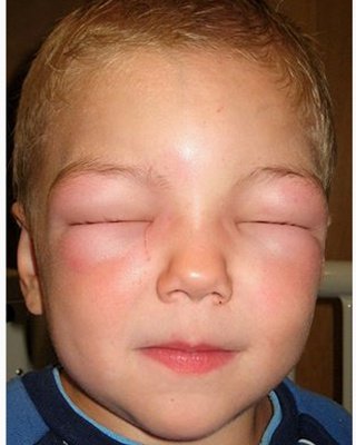 urticaria - angioedema palpebral