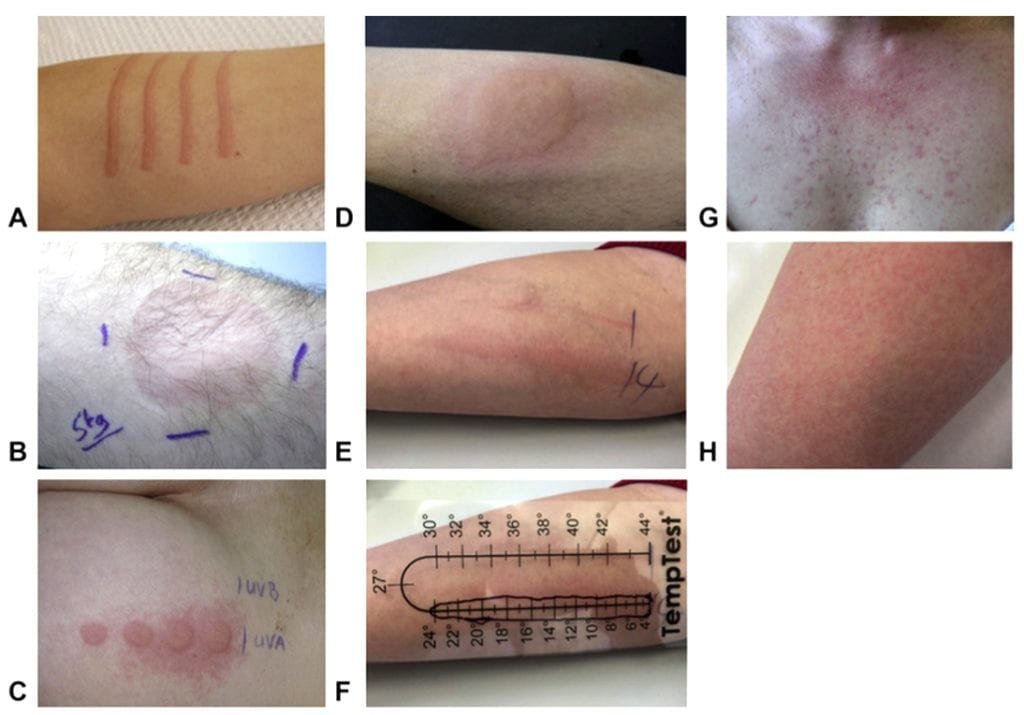 urticaria - fatores desencadeantes