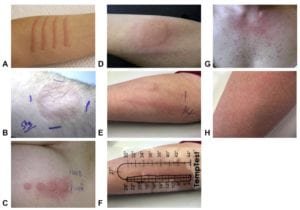 urticaria - fatores desencadeantes