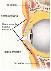 Celulite Pré-Septal (Periorbitária): o que é, como diagnosticar e tratar