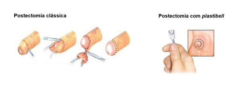 cirurgias para fimose