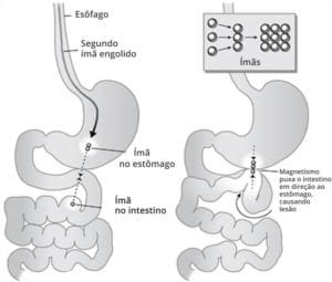 ingestao de imas - padrao de lesoes internas - pediatria
