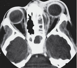 Celulites orbital e pré-septal - Distúrbios oftalmológicos - Manuais MSD  edição para profissionais