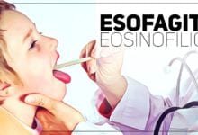 esofagite eosinofilica - pediatria