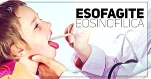 esofagite eosinofilica - pediatria