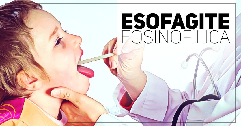 esofagite eosinofilica - pediatria