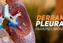 Derrame Pleural