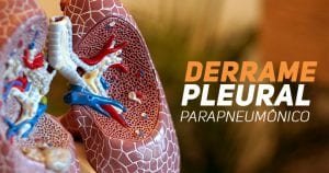 Derrame Pleural