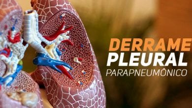 Derrame Pleural